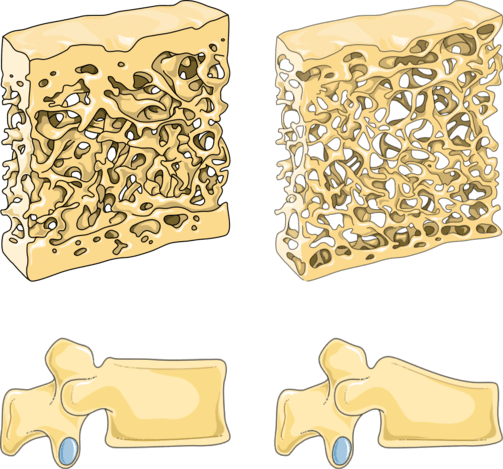 Osso com osteoporose (1)